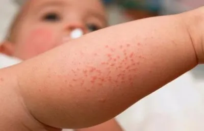 Аллергическая сыпь дерматит кожи пациента | Премиум Фото