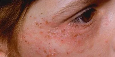 Лечение аллергии | Клиника Здоровья