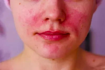 Аллергия на косметику: причины, симптомы, профилактика