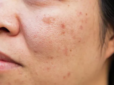 Аллергия на солнце: что делать, чем лечить, как выглядит на лице и коже
