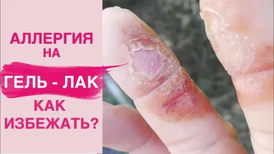 Аллергия на цветение или весенний поллиноз - как вылечить и как пережить?