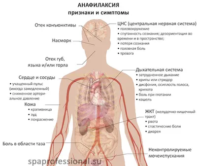 Анафилактический шок: симптомы, диагностика и лечение