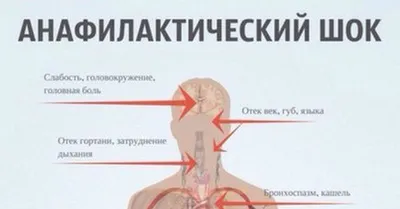 Анафилактический шок