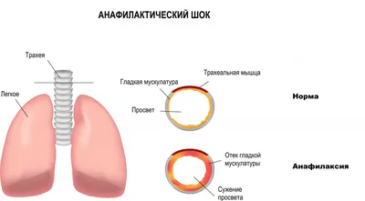 Анафилактический шок - первая помощь, симптомы, что это такое, лечение,  признаки