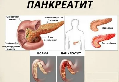 ПАНКРЕАТИТ. ЭТАПЫ ВОССТАНОВЛЕНИЯ — Сергей Гришин на 