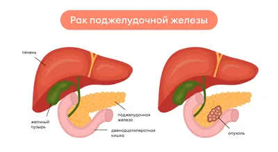 Рак поджелудочной железы: причины, симптопы, диагностика, лечение