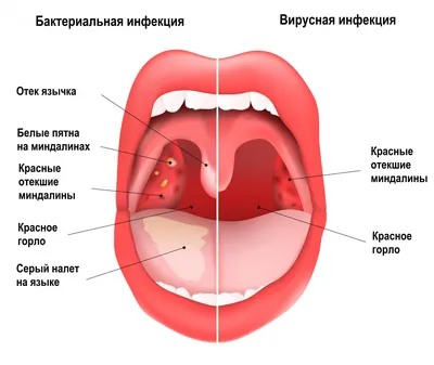 Ангина: причины, и симптомы, лечение, диагностика и профилактика ангины