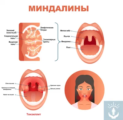 Ангина у детей: симптомы и лечение. Признаки, причины и диагностика ангины  у ребенка.