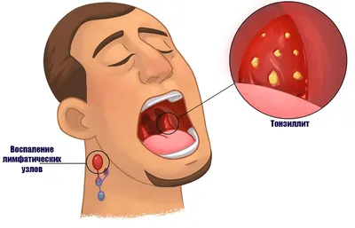 Может ли кариес стать причиной ангины - энциклопедия 