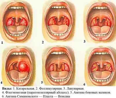 Лечение болезней педиатром: Ангина