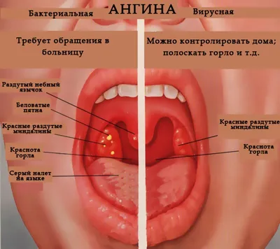 Ангина #51