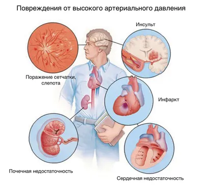 Что такое артериальная гипертензия? Описание, диагностика и лечение •  Степени артериальной гипертензии | Microlife