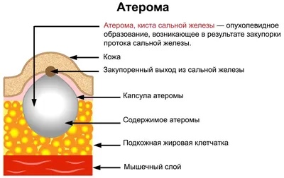 Атерома: фото, на голове, за ухом, на спине, лечение, удаление