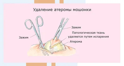 Удаляем атеромы лазером и хирургическим путем | Клиника АЛОДЕРМ Москва