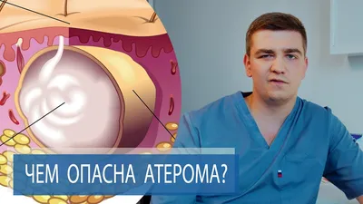 Атерома - что это и как это лечить? | Москва