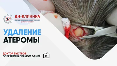 Атерома: фото, на голове, за ухом, на спине, лечение, удаление