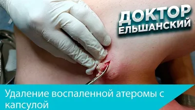 2.7. Атеромы, абсцессы и флегмоны кожи грудной стенки