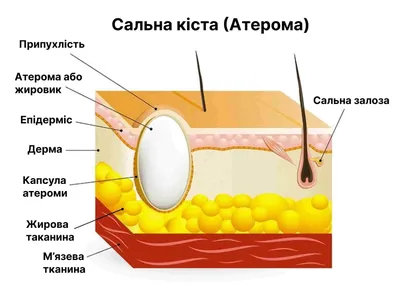 Удаление атером в Санкт-Петербурге многопрофильная медицинский центр ЦМД  Отзывы стоимость приема