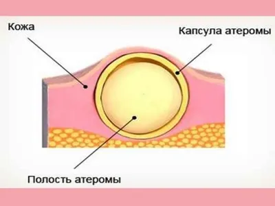 Как выглддяит атерома? Вид. УЗИ. Операция. Швы. Удаленная. Снятие швов.