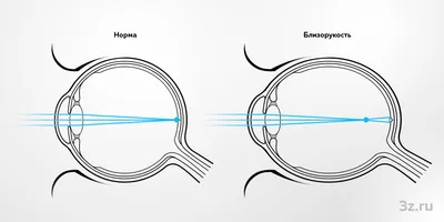 Миопия (Близорукость): причины, симптомы, лечение.