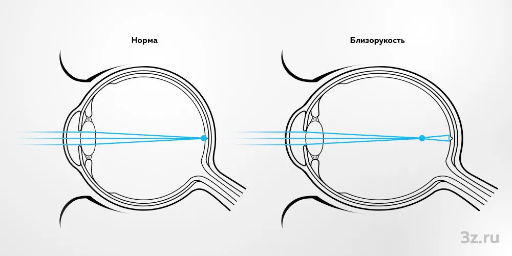 Глазное яблоко удлиненной формы это близорукость. Миопия схема глаза. Дальнозоркость глазное яблоко удлинённой формы. Схема глазного яблока при близорукости. Форма глазного яблока при близорукости и дальнозоркости.