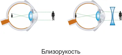 Откуда берётся миопия и как её лечить - Лайфхакер