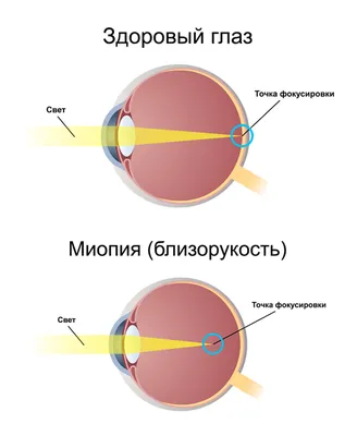 Лечение близорукости