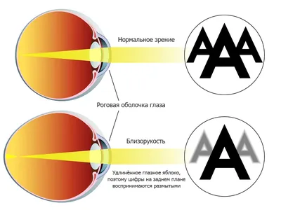 Миопия (близорукость) | Что это такое, степени, лечение и симптомы