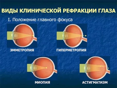 Близорукость и дальнозоркость ‒ в чем разница, где минус, а где плюс,  причины, всё простыми словами