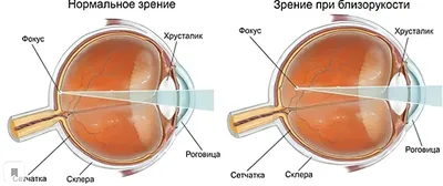 Лечение близорукости. Компания АртОптика г. Челябинск