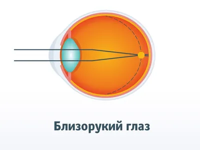 Близорукость и дальнозоркость