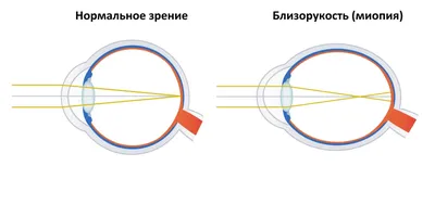 Как вылечить близорукость? - диагностика, лечение и коррекция