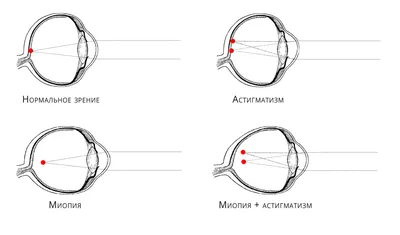 Близорукость: вопросы и ответы