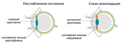 Миопическая болезнь (злокачественная близорукость) - диагностика и лечение