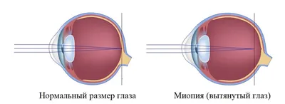 Близорукость у детей