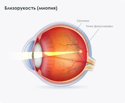 Особенности лечения близорукости, дальнозоркости и астигматизма | World  Vision Clinic