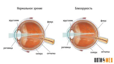 Близорукость более 6 диоптрий - энциклопедия 