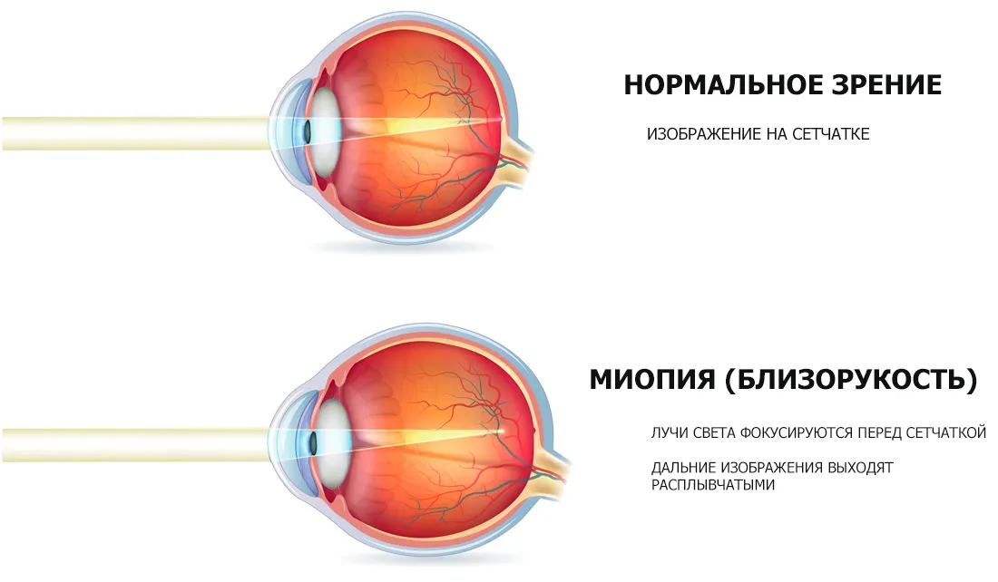 Зрение 3 лечение. Миопия фокус перед сетчаткой. Близорукость глазное яблоко удлиняется. Удлиненное глазное яблоко при близорукости. Близорукость и дальнозоркость глазное яблоко удлиненной формы.