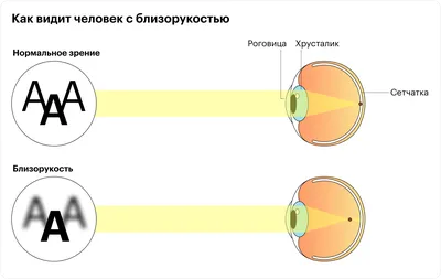 Возможно ли вылечить близорукость? - Сеть Салонов Оптика