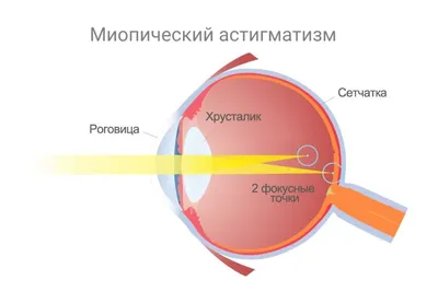 Близорукость симптомы и ее виды , способы лечения миопии