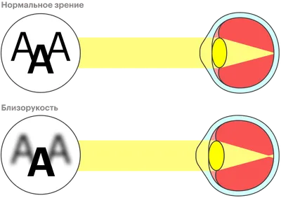 Аккомодационная и анатомическая близорукость: диагностика - энциклопедия  