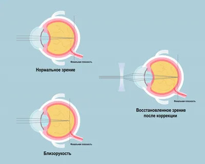 8 мифов о близорукости