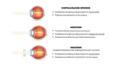 Причины близорукости и методы лечения【GlazGo】