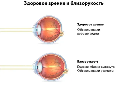 Близорукость. Дальнозоркость. Астигматизм. | Клиника Добрый Доктор г.  Красноярск