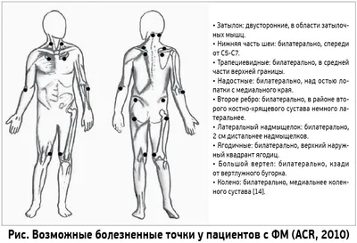 Фибромиалгия: этиология, патогенез, принципы диагностики и лечения