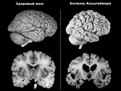 Болезнь Альцгеймера - статьи