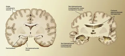 Внутренний враг. Ученые нашли новую причину болезни Альцгеймера - РИА  Новости, 
