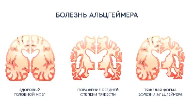 Болезнь Альцгеймера - причины появления, симптомы заболевания, диагностика  и способы лечения