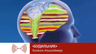 Болезнь Альцгеймера у пожилых людей: лечение, диагностика