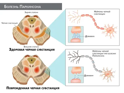 Болезнь Паркинсона: симптомы, стадии, диагностика и лечение | Блог ЛДЦ  Здоровье